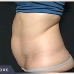 Liposuction Before & After Patient #772
