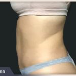 Liposuction Before & After Patient #772