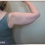 Liposuction Arms Before & After Patient #1418