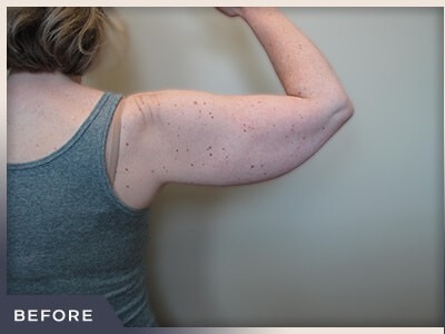 Liposuction Arms Before & After Patient #1418