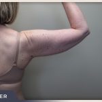 Liposuction Arms Before & After Patient #1418
