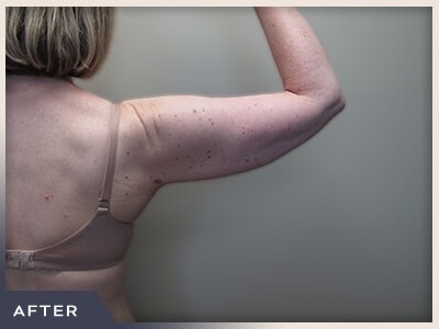 Liposuction Arms Before & After Patient #1418