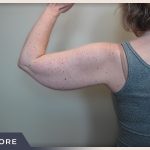 Liposuction Arms Before & After Patient #1418