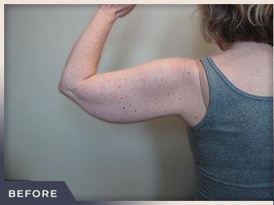 Liposuction Arms Before & After Patient #1418