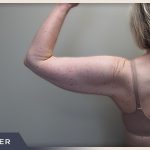 Liposuction Arms Before & After Patient #1418