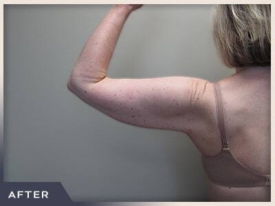 Liposuction Arms Before & After Patient #1418