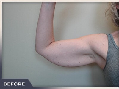 Liposuction Arms Before & After Patient #1418