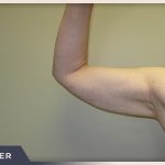 Liposuction Arms Before & After Patient #1418