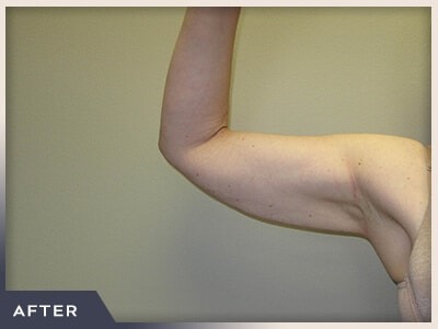 Liposuction Arms Before & After Patient #1418