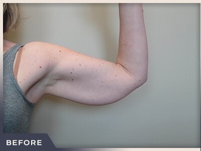 Liposuction Arms Before & After Patient #1418