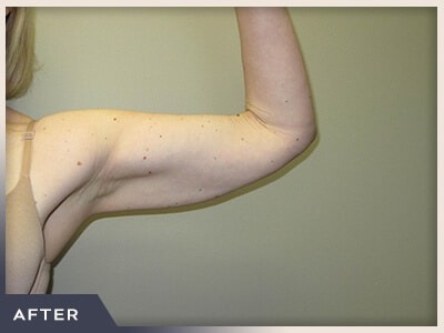 Liposuction Arms Before & After Patient #1418