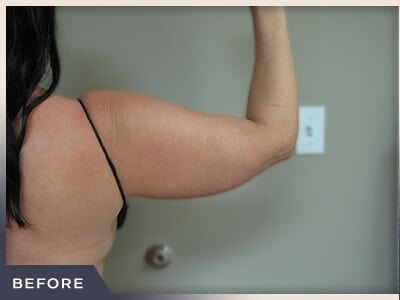 Liposuction Arms Before & After Patient #1421