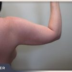 Liposuction Arms Before & After Patient #1421