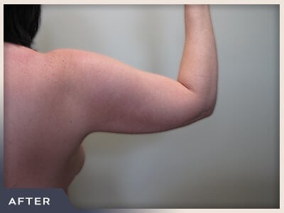 Liposuction Arms Before & After Patient #1421