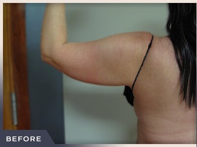 Liposuction Arms Before & After Patient #1421