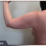 Liposuction Arms Before & After Patient #1421