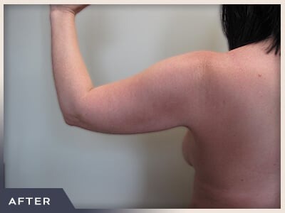 Liposuction Arms Before & After Patient #1421