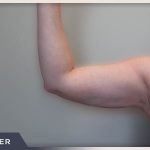 Liposuction Arms Before & After Patient #1421