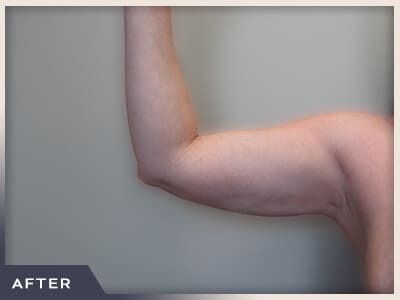 Liposuction Arms Before & After Patient #1421
