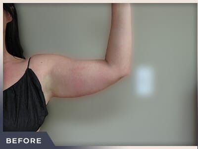 Liposuction Arms Before & After Patient #1421