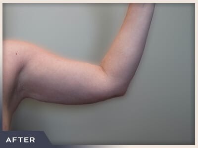 Liposuction Arms Before & After Patient #1421