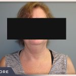 Neck Liposuction Before & After Patient #804