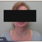Neck Liposuction Before & After Patient #804