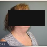 Neck Liposuction Before & After Patient #804
