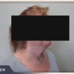 Neck Liposuction Before & After Patient #804