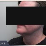 Neck Liposuction Before & After Patient #803