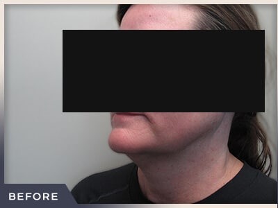Neck Liposuction Before & After Patient #803