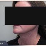 Neck Liposuction Before & After Patient #803