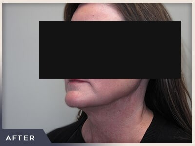 Neck Liposuction Before & After Patient #803