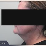 Neck Liposuction Before & After Patient #803