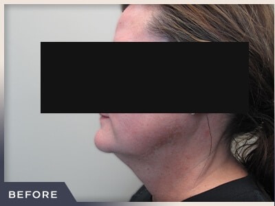 Neck Liposuction Before & After Patient #803