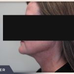 Neck Liposuction Before & After Patient #803