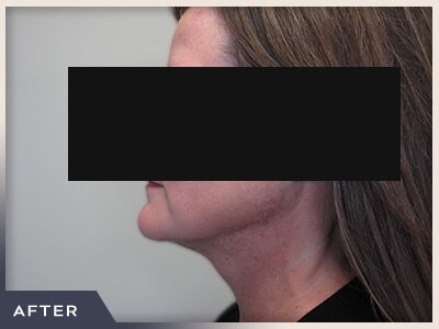 Neck Liposuction Before & After Patient #803