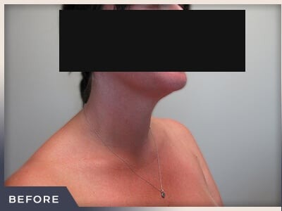 Neck Liposuction Before & After Patient #802