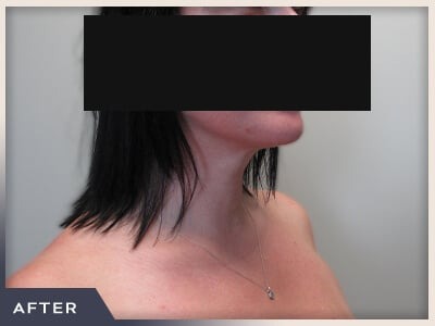 Neck Liposuction Before & After Patient #802