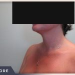 Neck Liposuction Before & After Patient #802