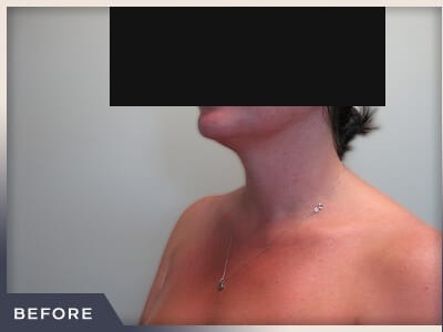 Neck Liposuction Before & After Patient #802