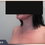 Neck Liposuction Before & After Patient #802