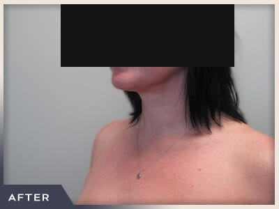 Neck Liposuction Before & After Patient #802