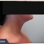 Neck Liposuction Before & After Patient #802