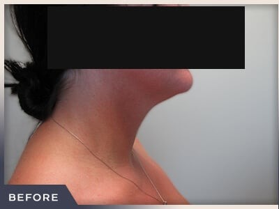 Neck Liposuction Before & After Patient #802
