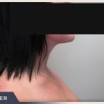 Neck Liposuction Before & After Patient #802