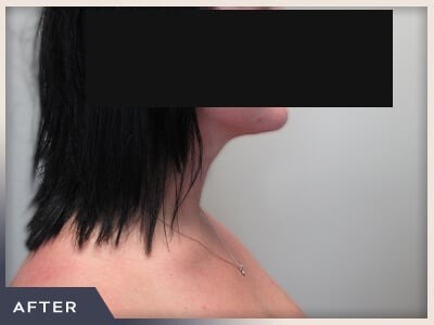 Neck Liposuction Before & After Patient #802