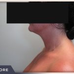 Neck Liposuction Before & After Patient #802