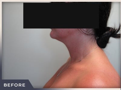 Neck Liposuction Before & After Patient #802