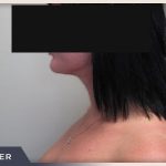 Neck Liposuction Before & After Patient #802
